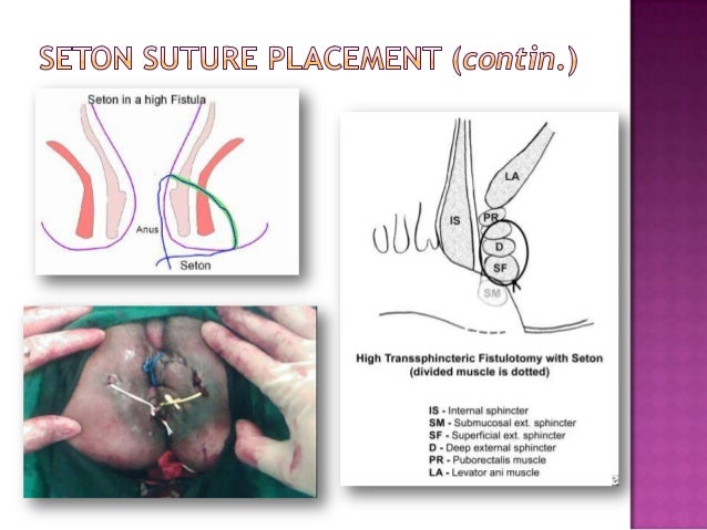 seton drain for an anal fistula Casting anal gif
